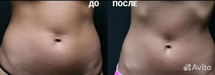 Липосакция, жиротоп и похудение Липосоникс