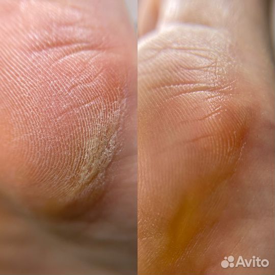 Подолог. Вросший ноготь. Титановая нить