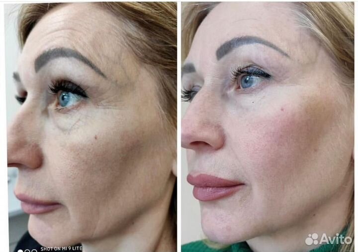 Омоложение Подтяжка лица СМАС лифтинг