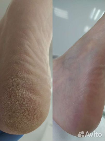 Подолог, педикюр