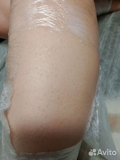 Электроэпиляция