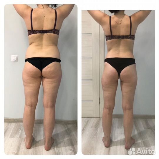 Лимфодренажный массаж