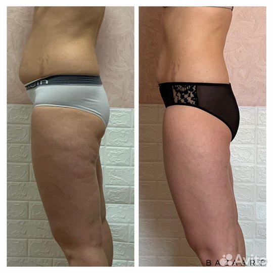 Массажlpg,прессотерапия,медовый,спа