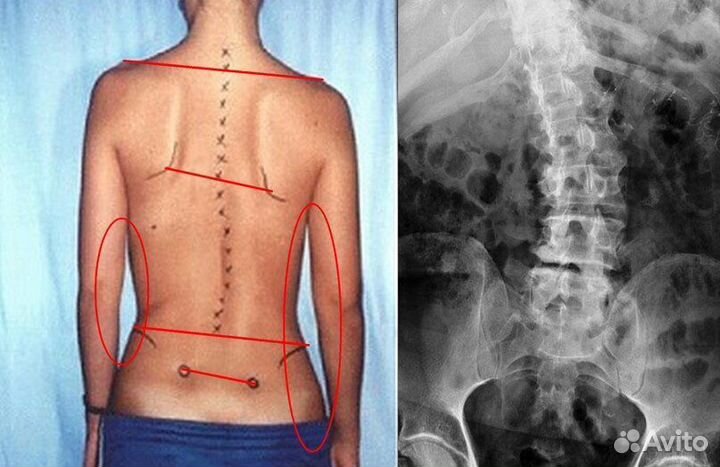 FDM Массаж лучше чем Мануальный терапевт