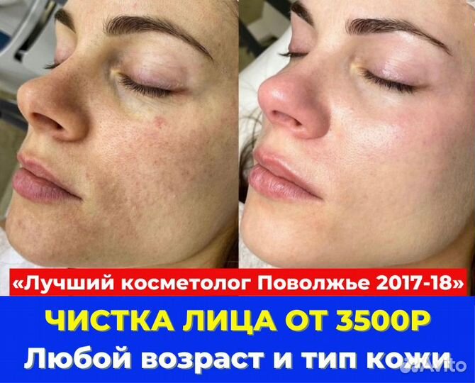Чистка лица, пилинг, гидропилинг