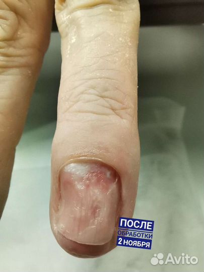 Подологический педикюр