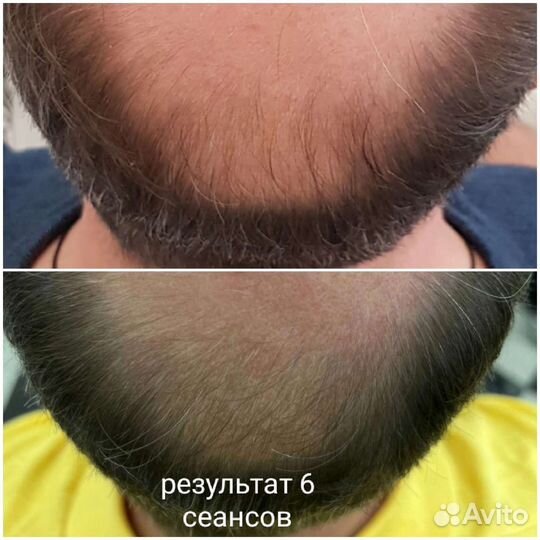 Лечение выпадения волос