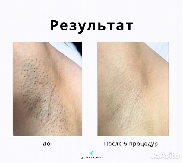 Диодный лазер для эпиляции Lumines’ Max’One 1200 Вт