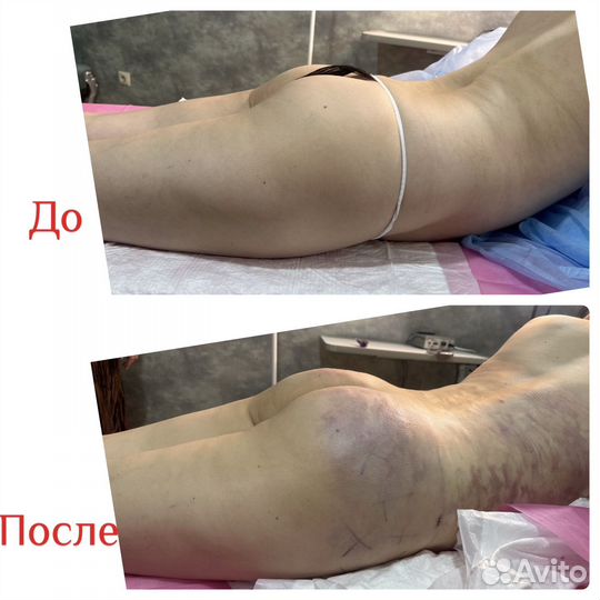 Липосакция рук