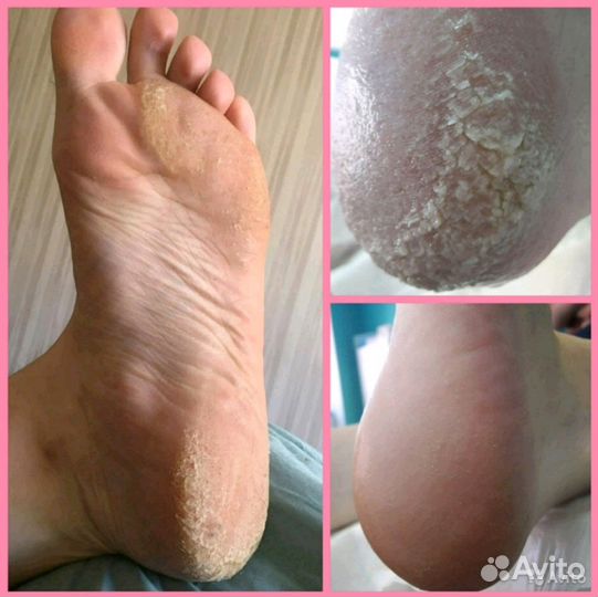 Медицинский педикюр