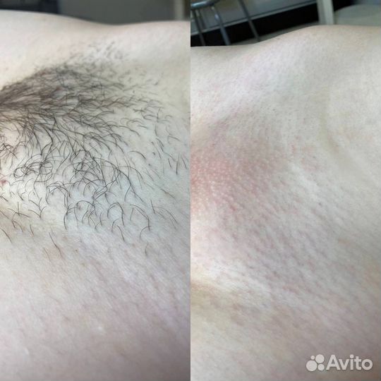 Шугаринг депиляция