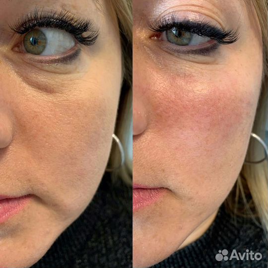 Скульптурный массаж лица Удаление папиллом