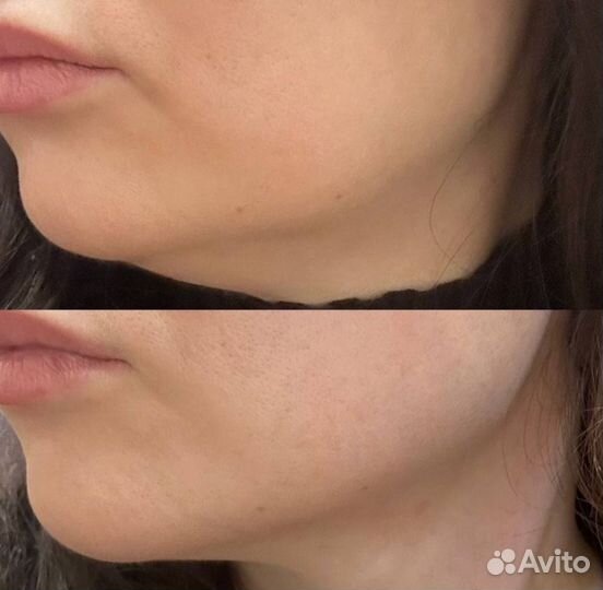 Модели на липолитики