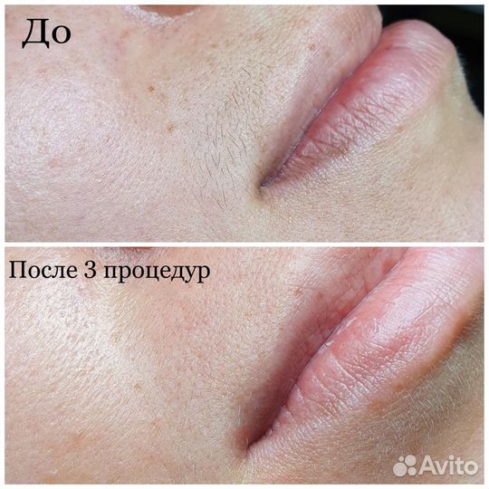 Лазерная эпиляция
