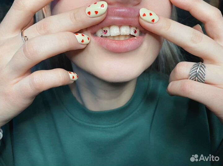 Установка скайсов (кристаллов/страз на зубы)