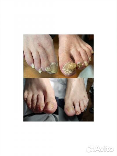 Мед. Педикюр1500/Титан1500