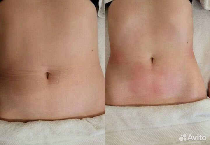 Аппаратный массаж.Коррекция фигуры.Похудение