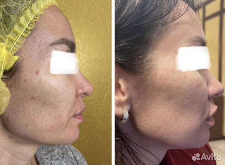 Омоложение холодной плазмой