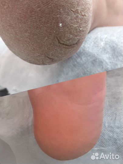 Педикюр любой сложности, титановая нить