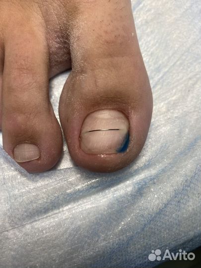 Подолог(вросший ноготь,трещины,мозоли бородавки)