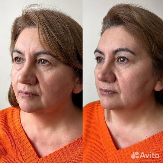 Аксесс Фейслифт, Аксесс барс, мтвсс