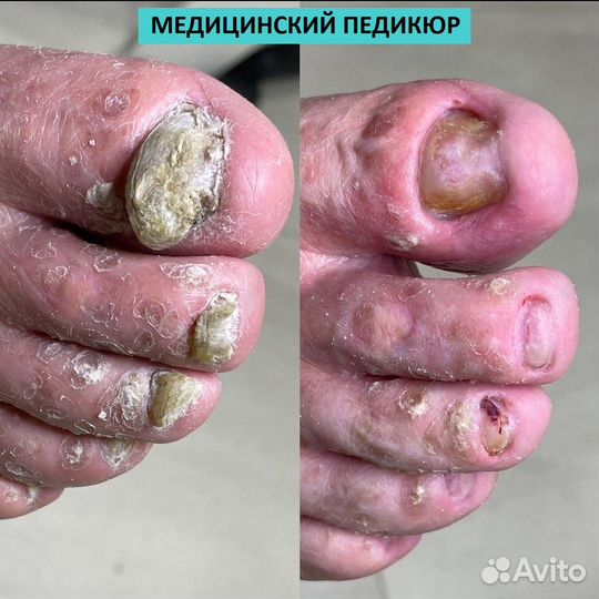 Медицинский педикюр. подолог