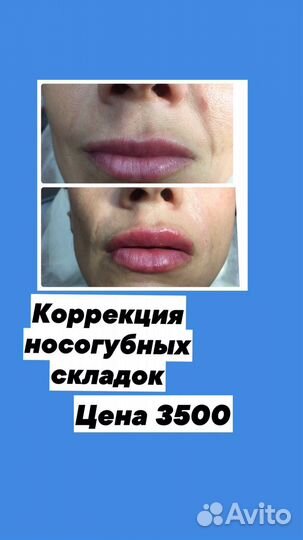 Контурная пластика губ