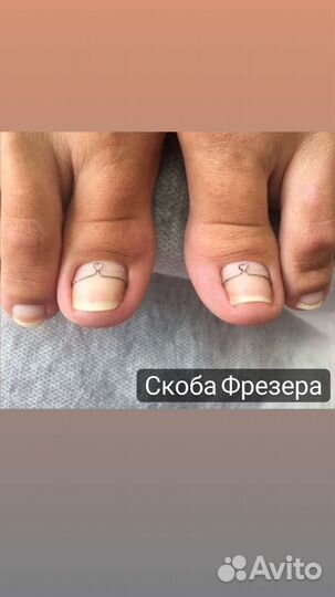 Коррекция вросших ногтей