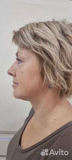 Смас лифтинг