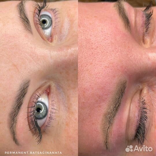 Удаление татуажа