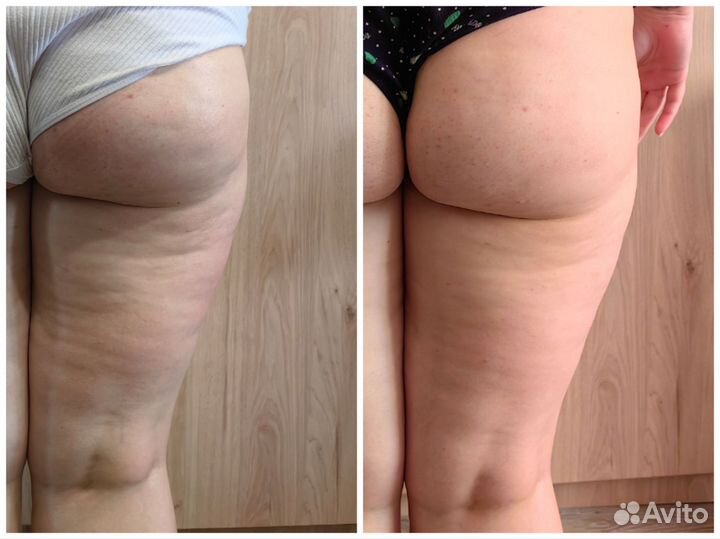 Вибромассаж