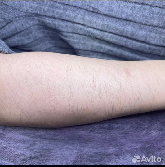 Электроэпиляция
