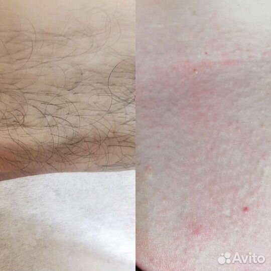 Депиляция воском, сахаром