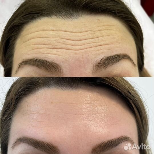 Смас лифтинг лица