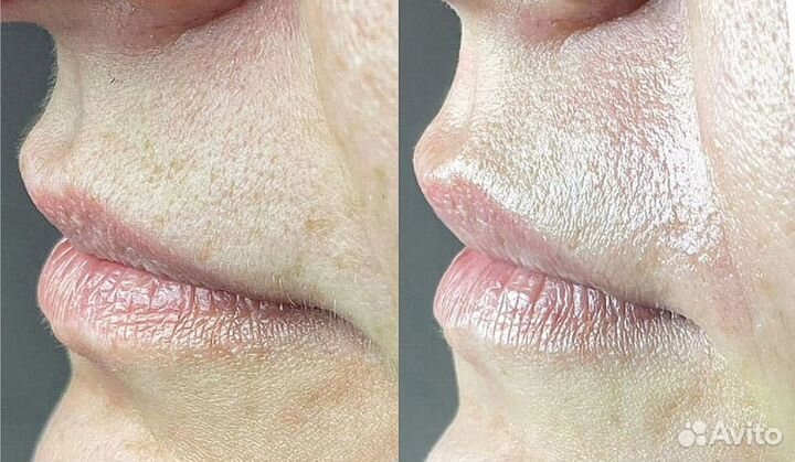 Шугаринг/воск/депиляция