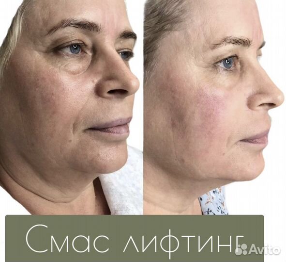 Смас лифтинг