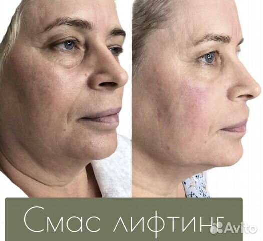Смас лифтинг