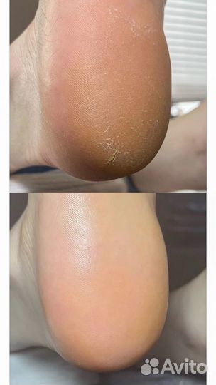 Педикюр с покрытием гель лак