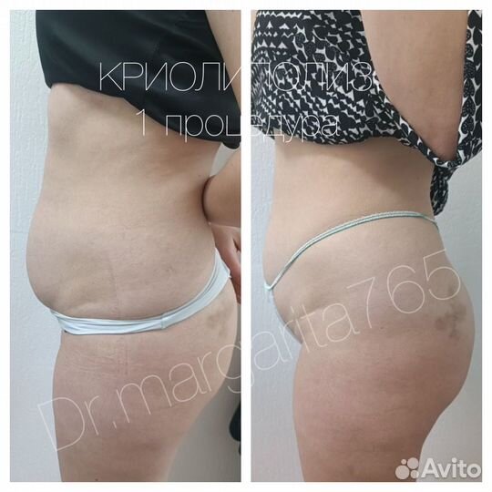 Массаж Криолиполиз Кавитация