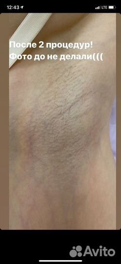 Электроэпиляция