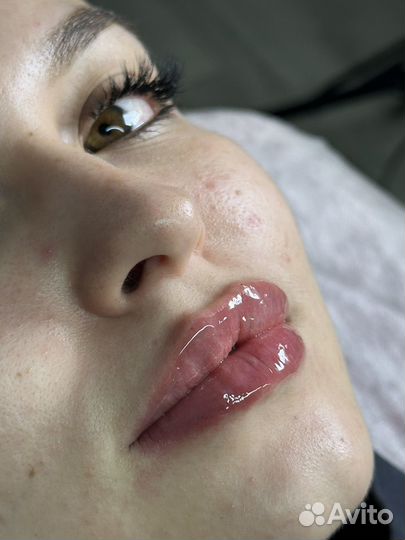 Контурная пластика губ