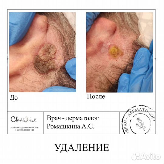 Удаление папиллом, родинок, бородавок