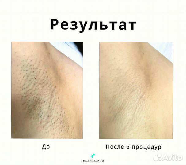 Аппарат для эпиляции Лю-Минес Макс’Ван 1200