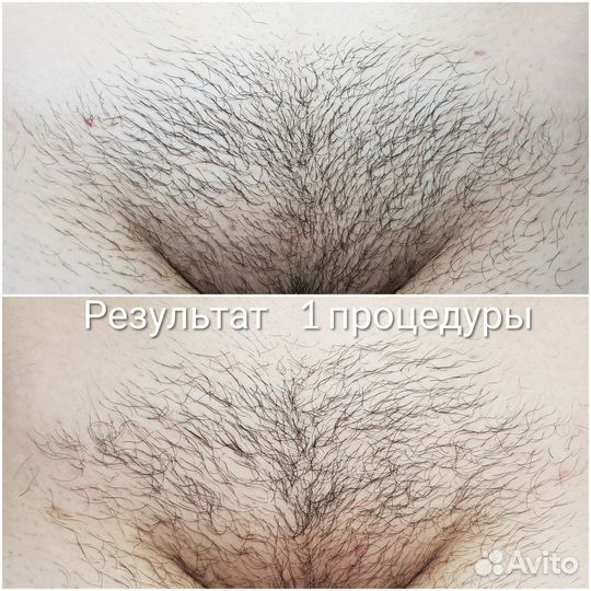 Электроэпиляция