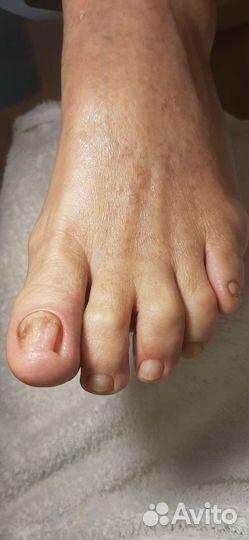 Медицинский педикюр,подолог