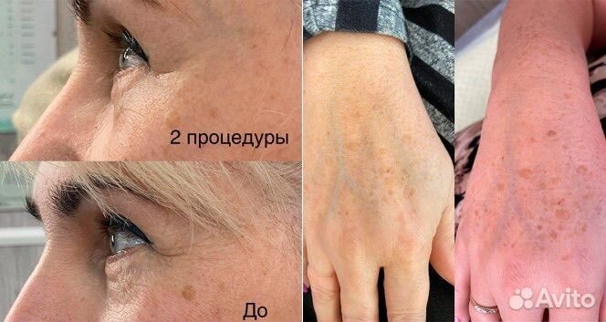 Холодная плазма лифтинг омоложение лица