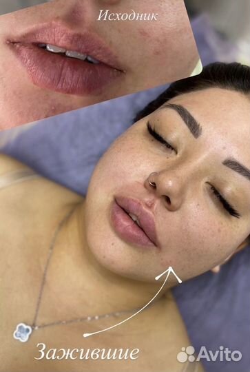 Увеличение губ