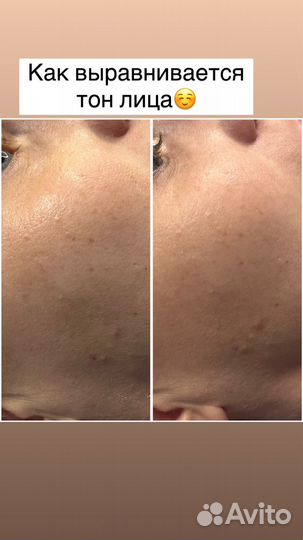 Фракционная мезотерапия/микронидлинг/bbglow