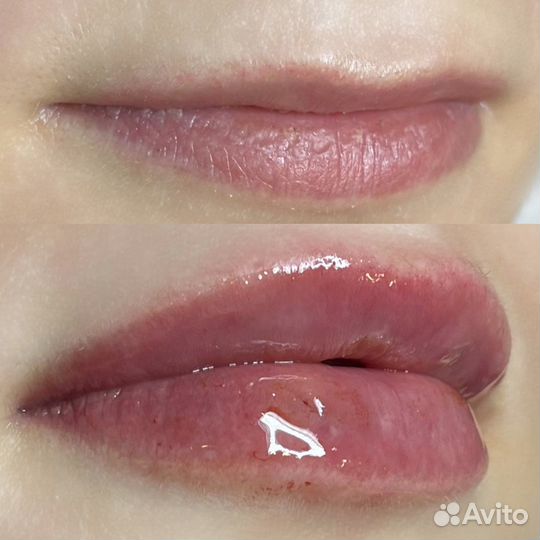 Косметолог. Губы