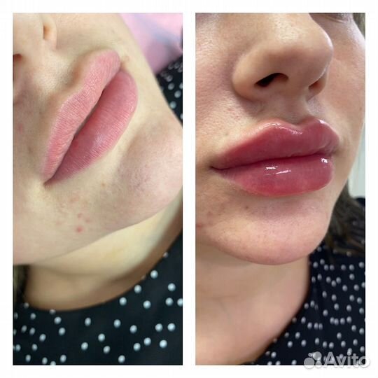 Увеличение губ